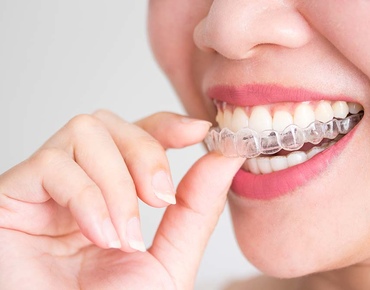 Как выровнять зубы без брекетов: подробный обзор альтернативных методов