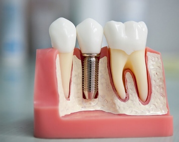 Особенности, преимущества и риски имплантации зубов
