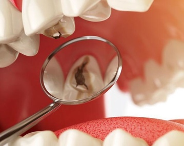 Лечение кариеса в частной стоматологии — сколько стоит?