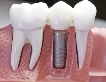 Что такое имплантация зубов и сколько она стоит?