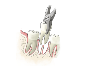 Удаление зуба: как происходит, показания к удалению, что делать после удаления
