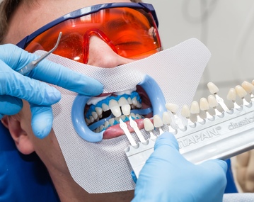 Профессиональное отбеливание зубов в стоматологии: сколько стоит и как происходит