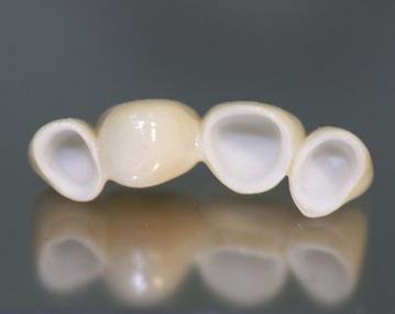 Чем отличается протезирование зубов с имплантацией и без имплантации? Стоимость протезирования