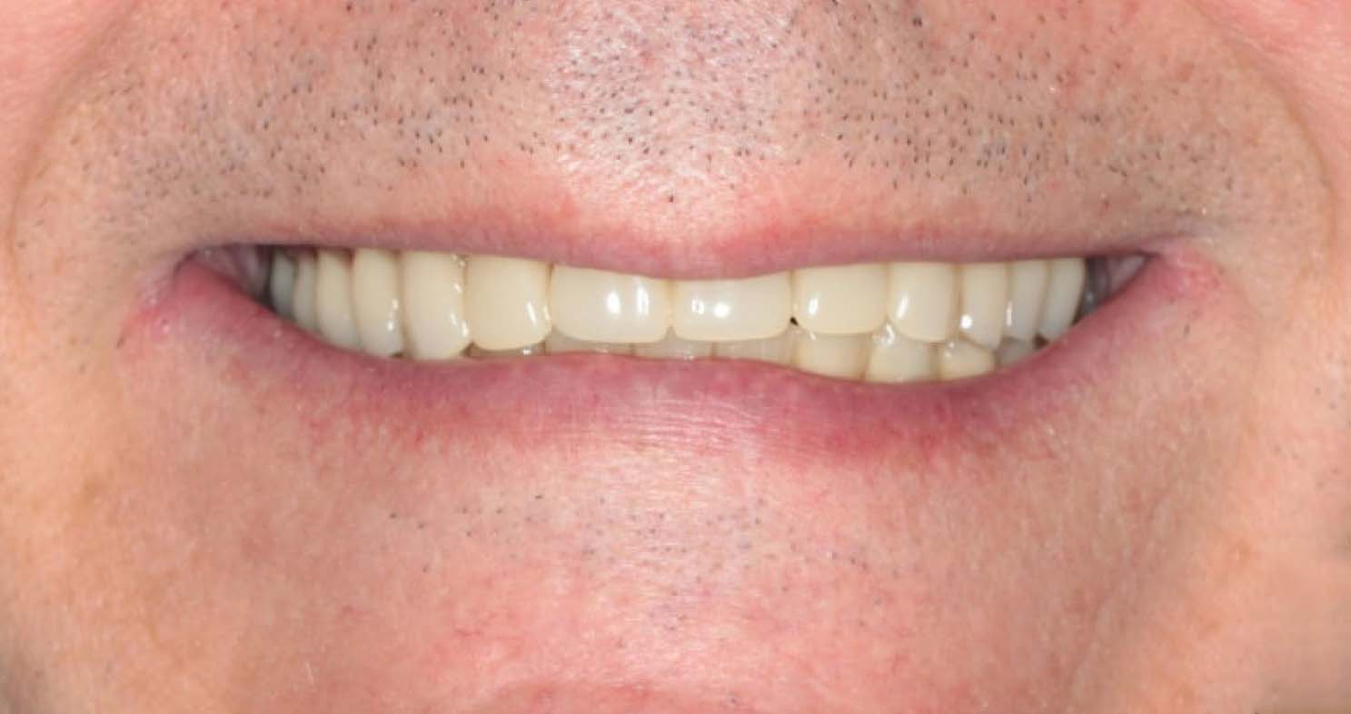 зубы мужчины после имплантации