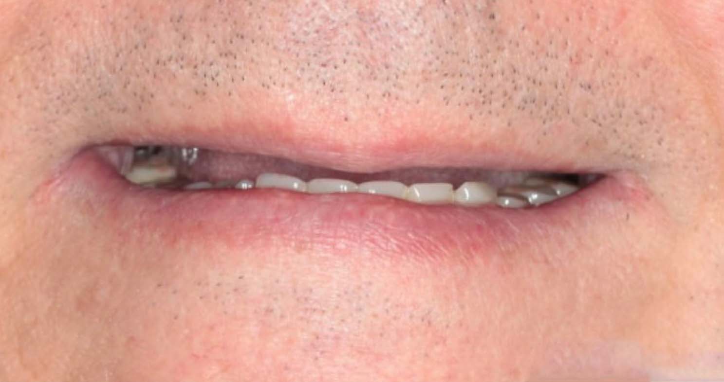 зубы мужчины до имплантации