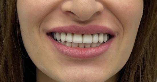 зубы девушки после установки виниров E-max
