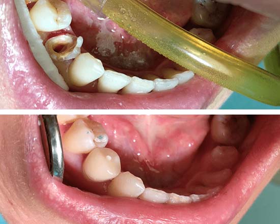 Жевательный зуб до и после установки коронки