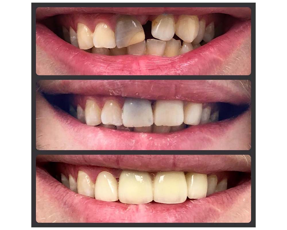 Зубы до и после установки коронок