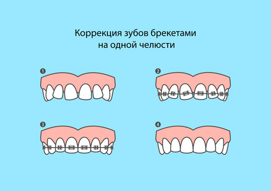 Коррекция зубов брекетами на одной челюсти