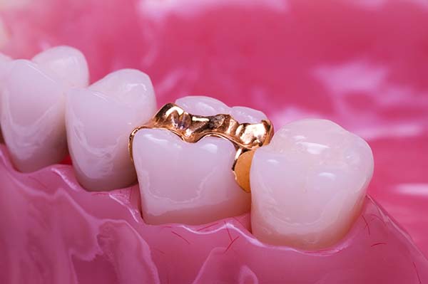 Золотая вкладка на жевательном зубе