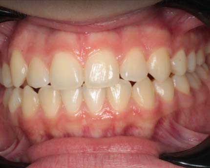 Состояние зубного рядо после лечения брекетами