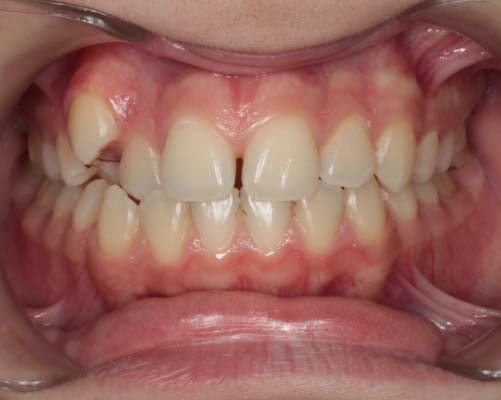 Состояние зубного рядо до лечения брекетами