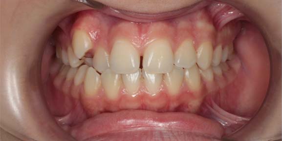 Молодая пациентка с кривыми зубами и диастемой