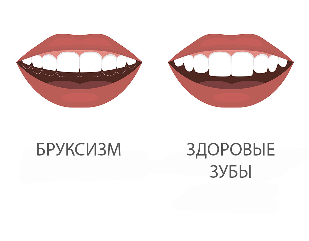 Сравнение нездоровых зубов от бруксизма со здоровыми