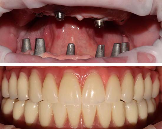 Фото до и после имплантации зубов на верхней и нижней челюстях