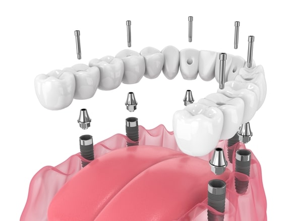 3д модель имплантации зубов на 6 имплантах