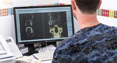 Стоматолог планирует на компьютере установку имплантов