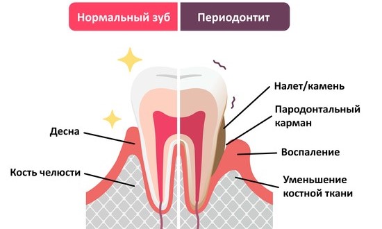 сравнение: здоровый зуб и периодонтит