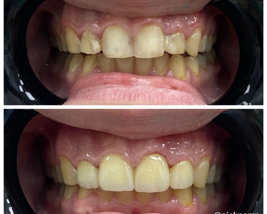 зубы до и после установки керамических коронок