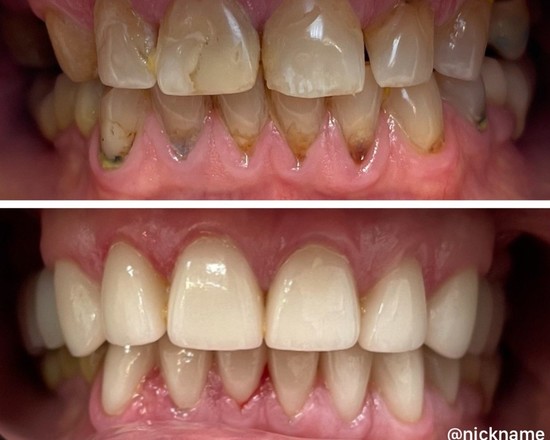 зубы до и после установки коронок из диоксида циркония