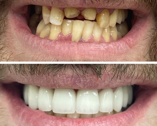 фото зубов до и после установки циркониевых коронок